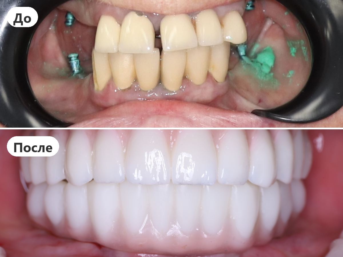 До и после лечения, пациент клиники Denta